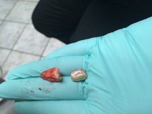 tooth
